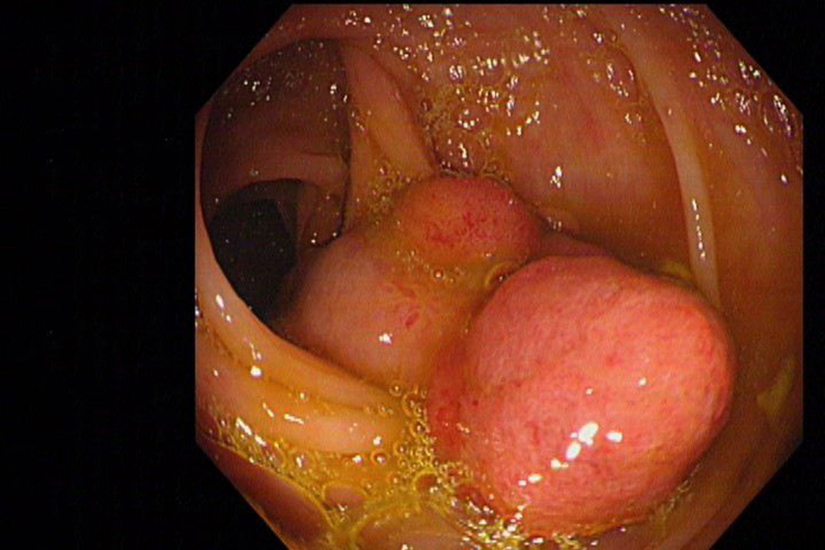 良性肠息肉图片直肠图片