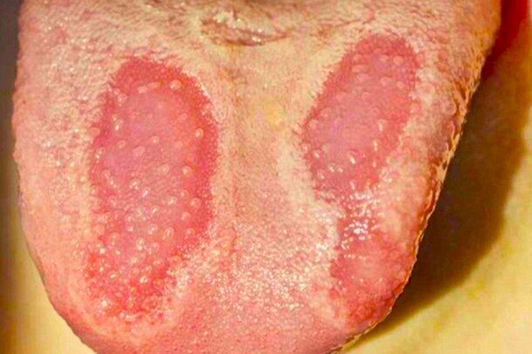 脾胃湿热地图舌图 脾胃湿热地图舌图