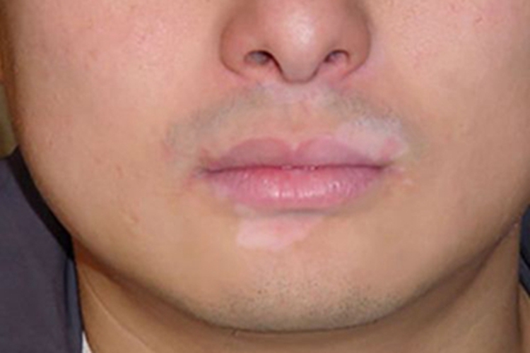 进展期节段型白癜风口周长白斑图