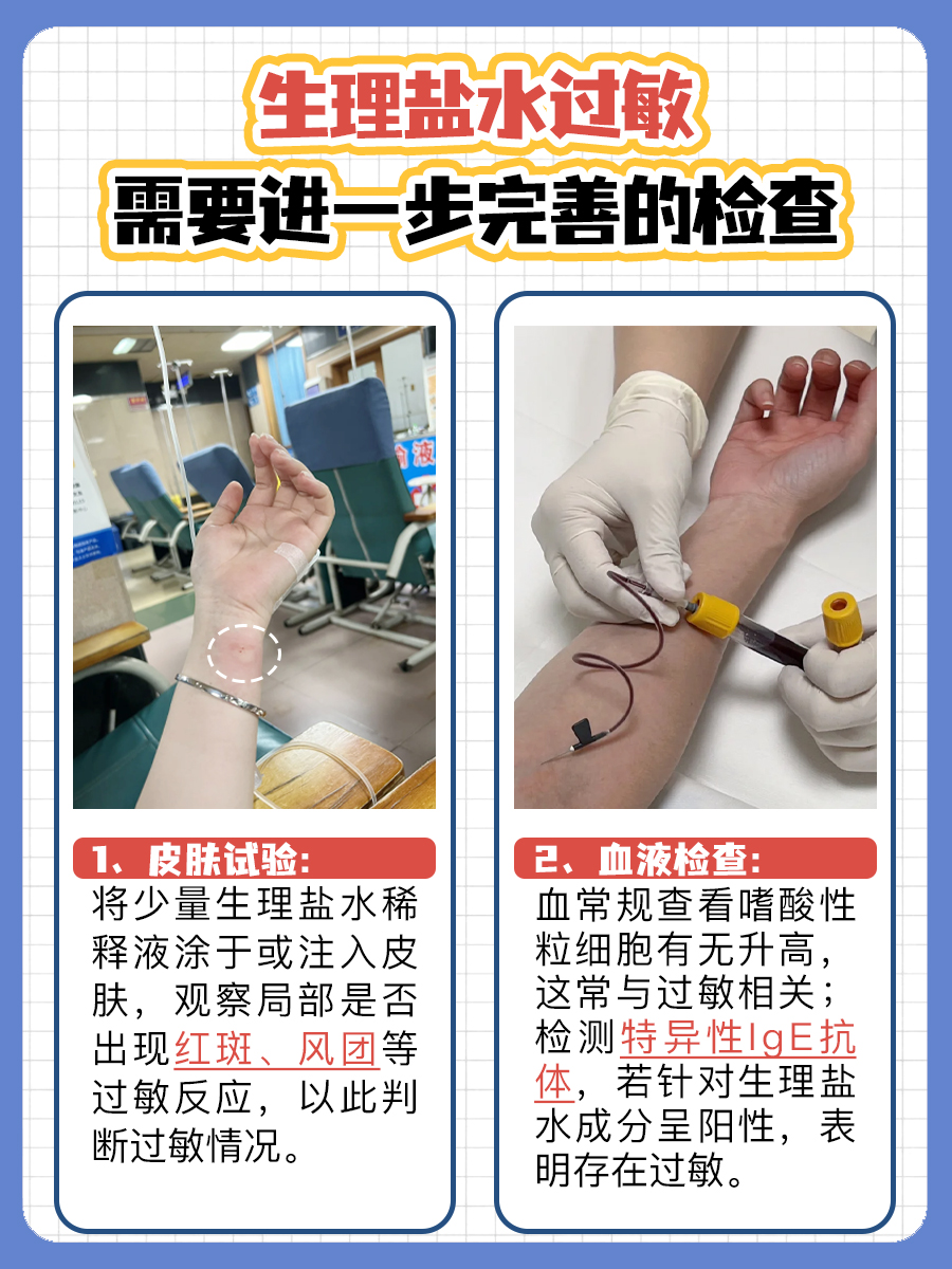 好奇！生理盐水过敏身体什么反应？带你深挖！