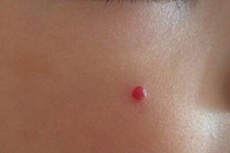 良性幼年黑色瘤面部红色结节图