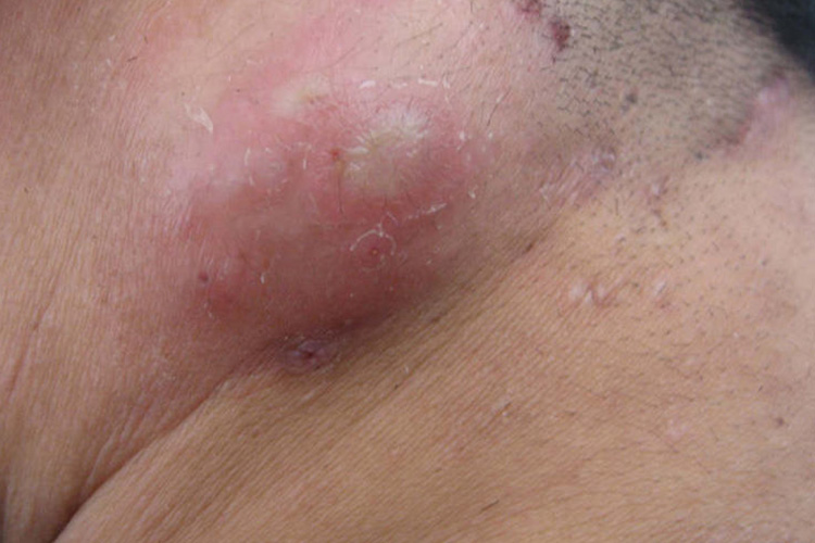 痈表面出现脓栓图