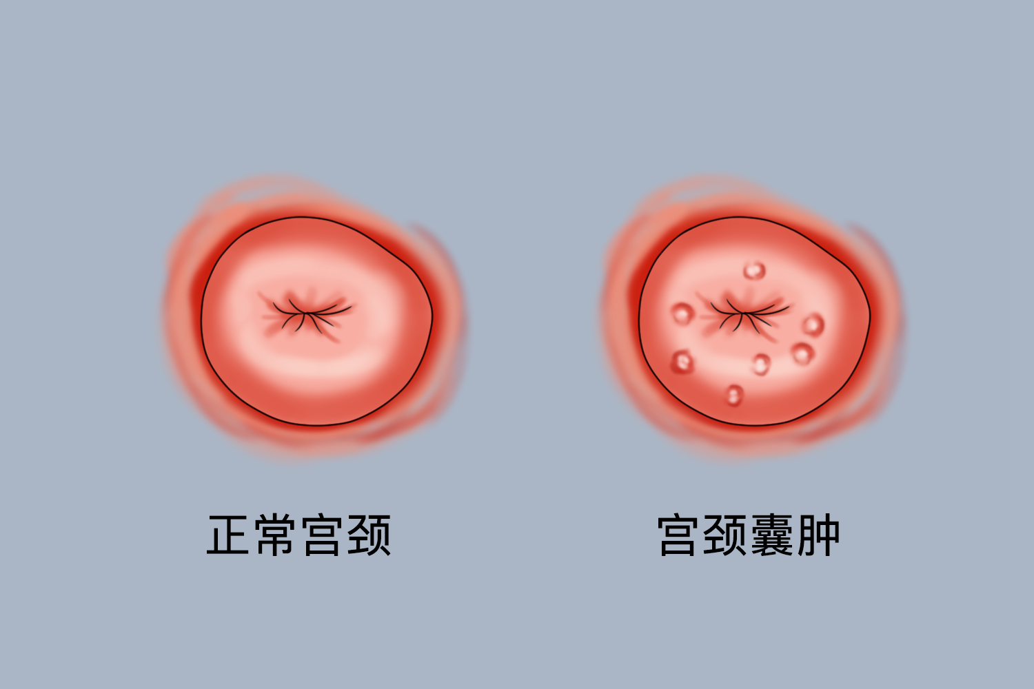 子宫颈腺囊肿图