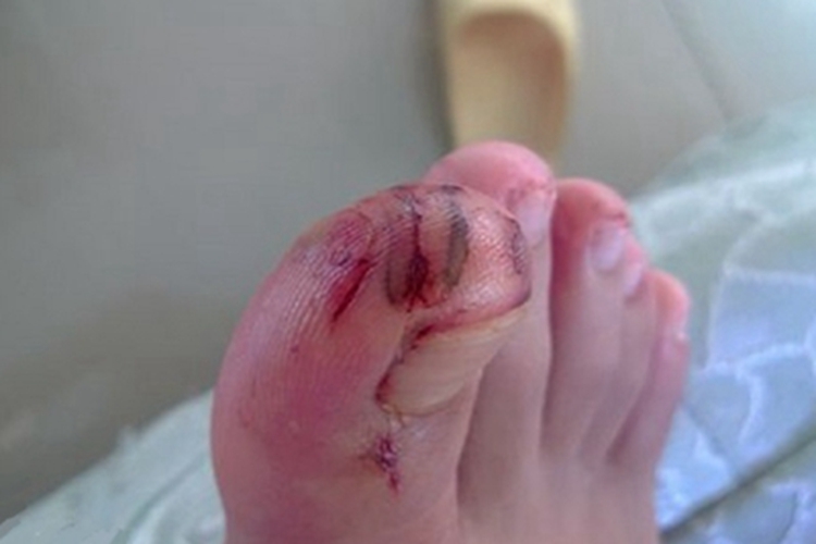 破伤风脚部伤口红肿图