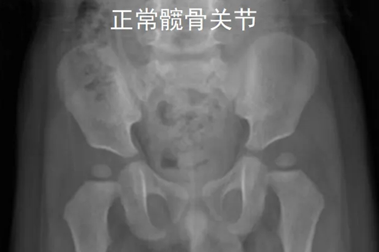 宝宝正常髋关节图 宝宝正常髋关节图