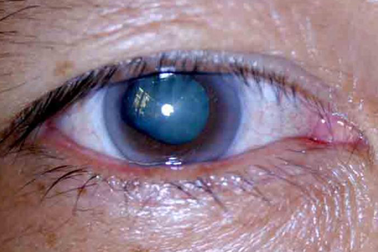 青光眼眼睛失明瞳孔变白图