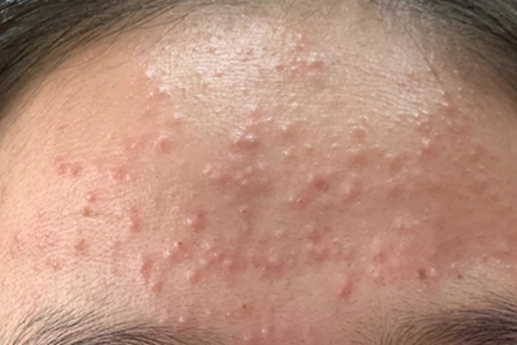 反应性穿通性胶原病症状图