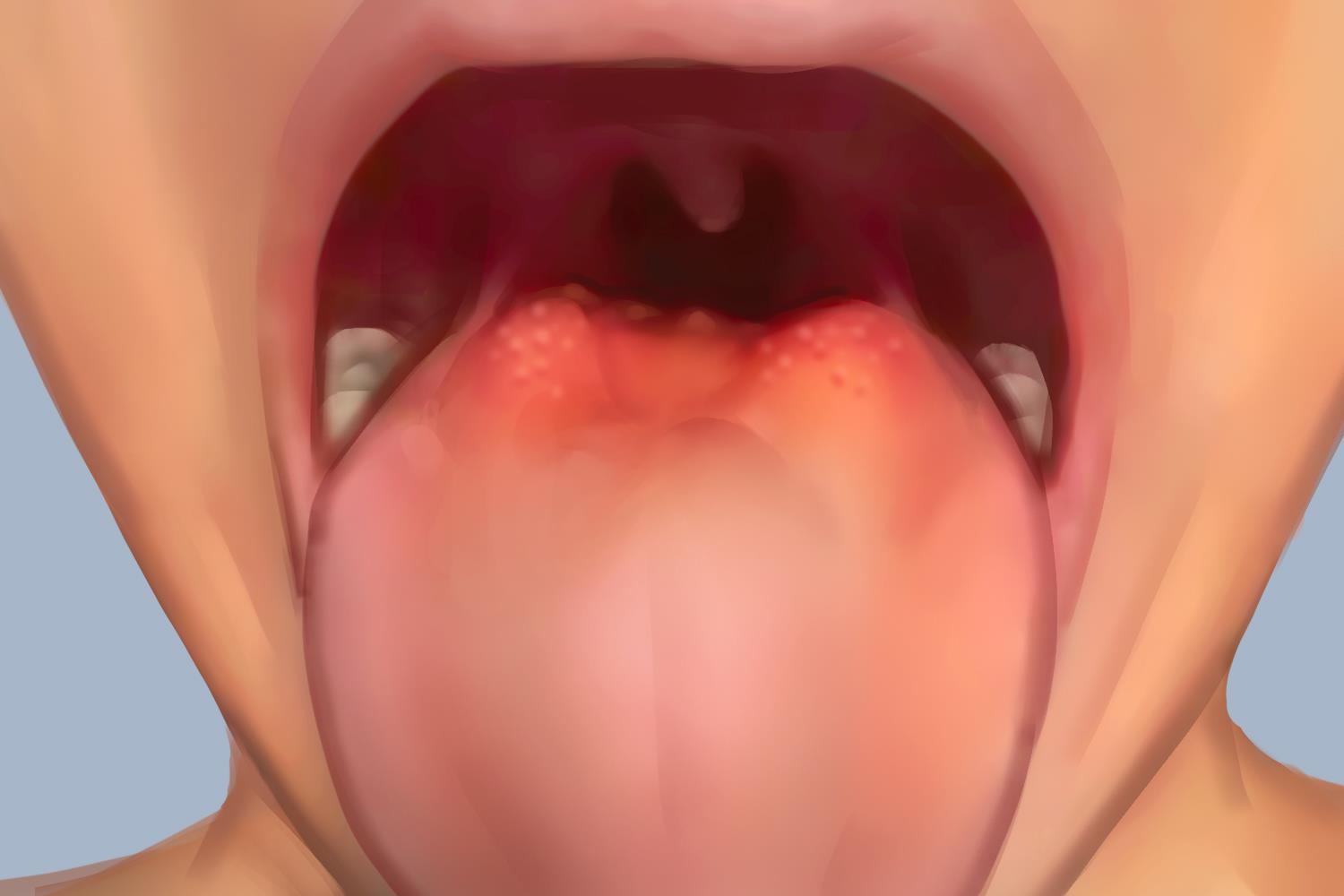 舌扁桃体肥大图