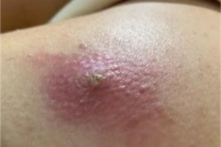 皮肤蝇蛆病肩部红肿图 皮肤蝇蛆病肩部红肿图