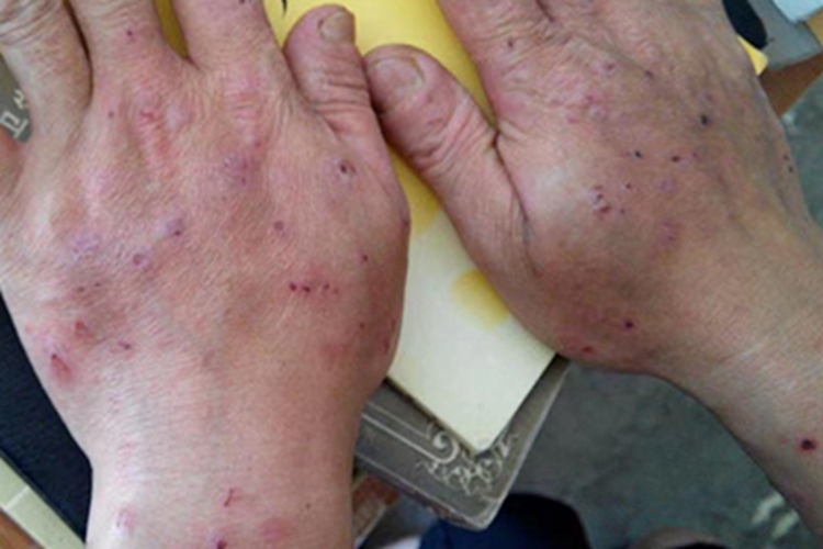 亚急性湿疹手背血痂图