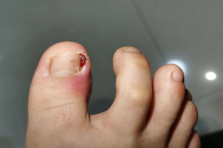 嵌甲脚趾甲肿图