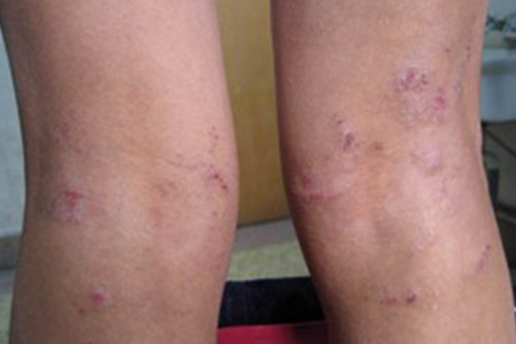 光化性扁平苔藓腘窝红色斑块图