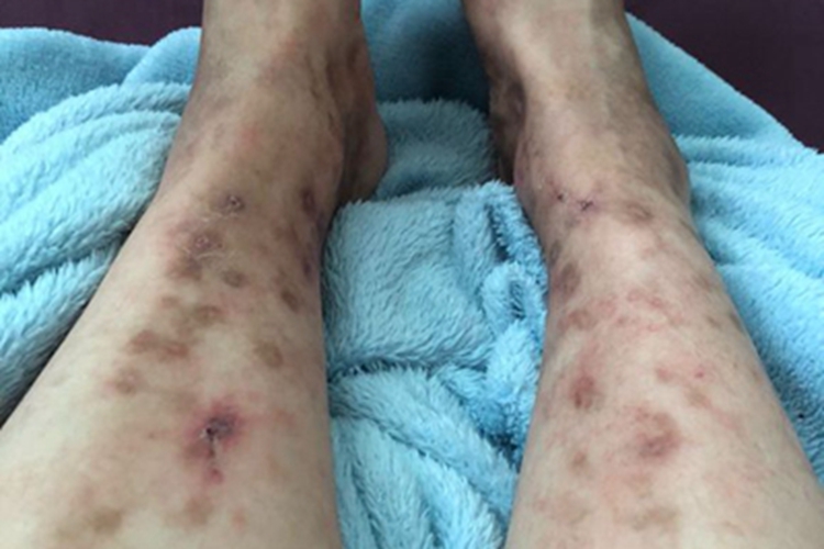 变应性血管炎小腿有斑图