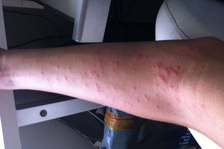 急性自发性荨麻疹红点图 急性自发性荨麻疹红点图