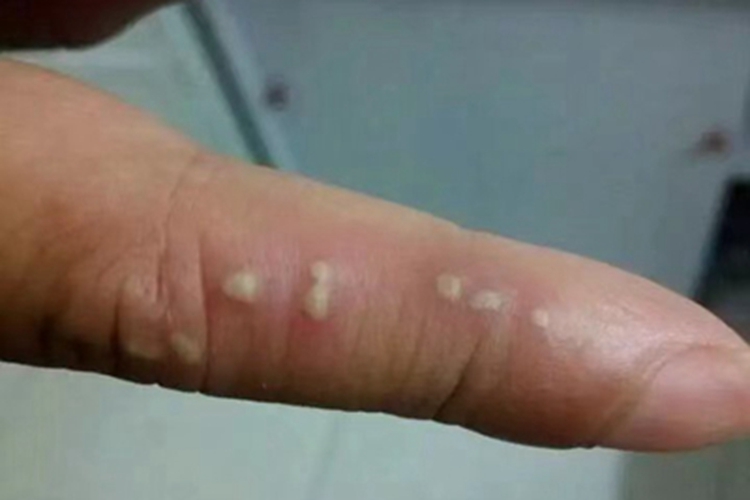 疱疹样脓疱病手指脓包图 疱疹样脓疱病手指脓包图