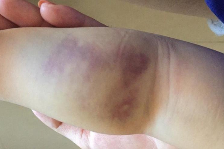 血友病人皮肤图 血友病人皮肤图
