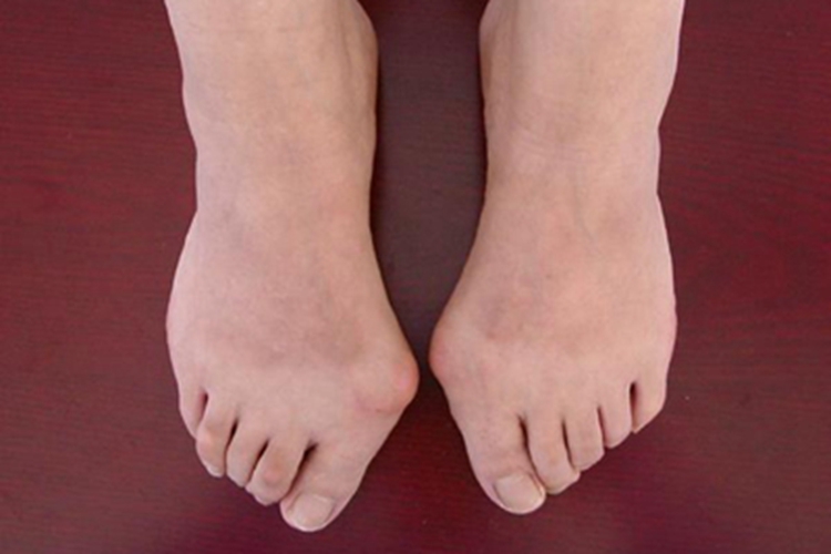 拇囊炎双脚脚趾变形图