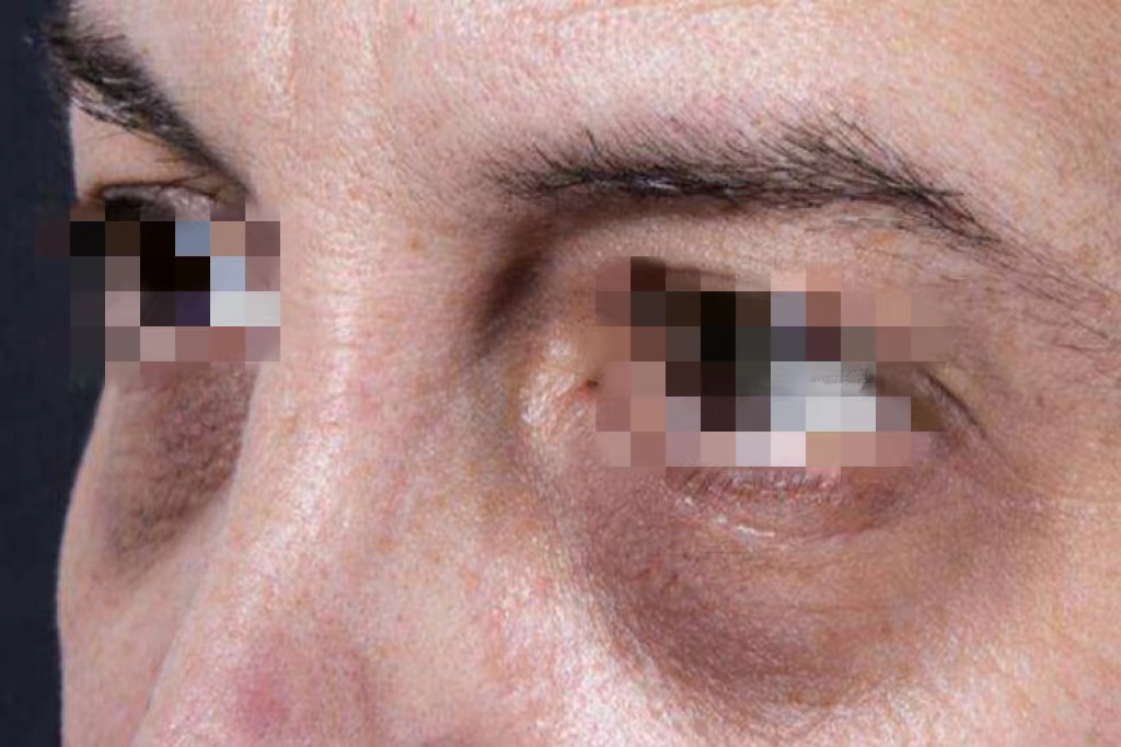 肝脏型黑眼圈图