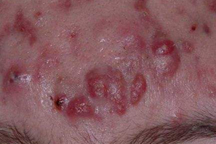 聚合性痤疮疙瘩图