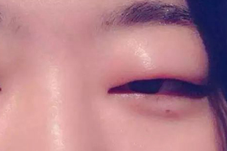 泪腺脱垂眼睛肿的睁不开图