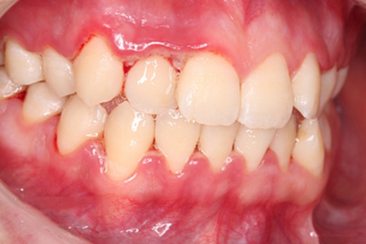 急性坏死性溃疡性龈炎牙龈肿图 急性坏死性溃疡性龈炎牙龈肿图
