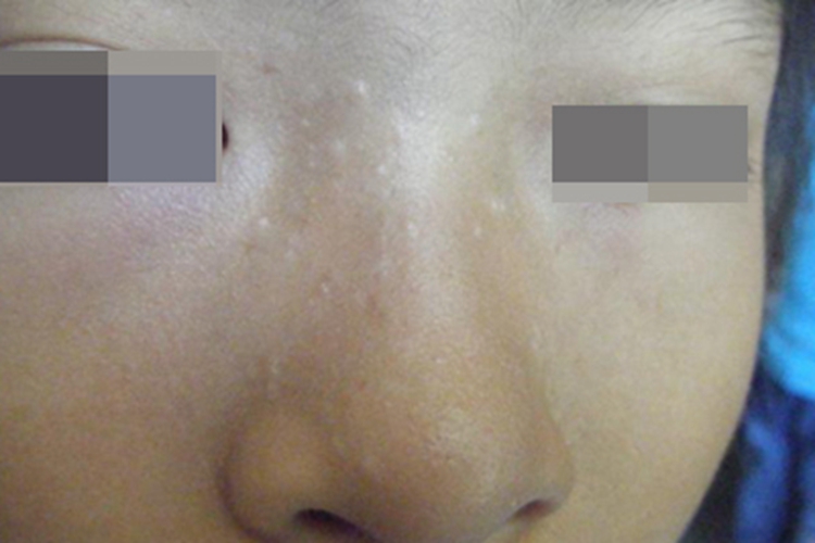 多发性毛发上皮瘤鼻部丘疹图 多发性毛发上皮瘤鼻部丘疹图