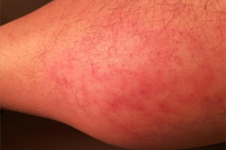 为什么脚上长红色点点