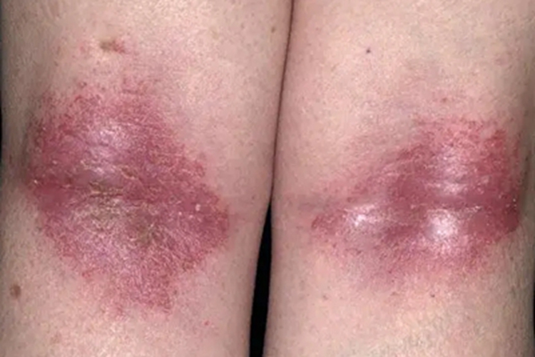 特应性皮炎腘窝症状图