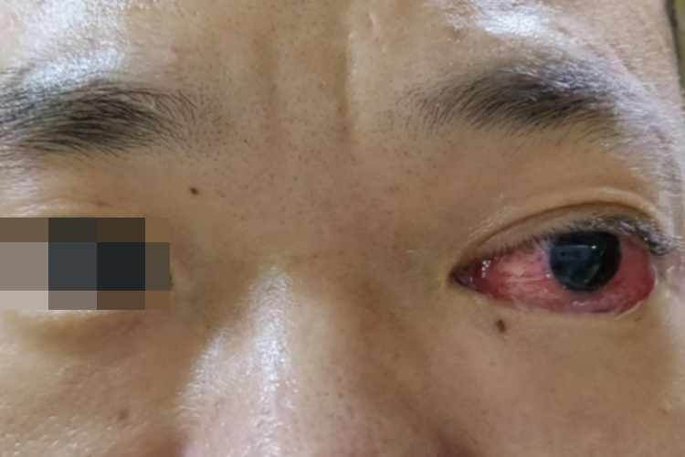 球结膜弥漫性水肿图