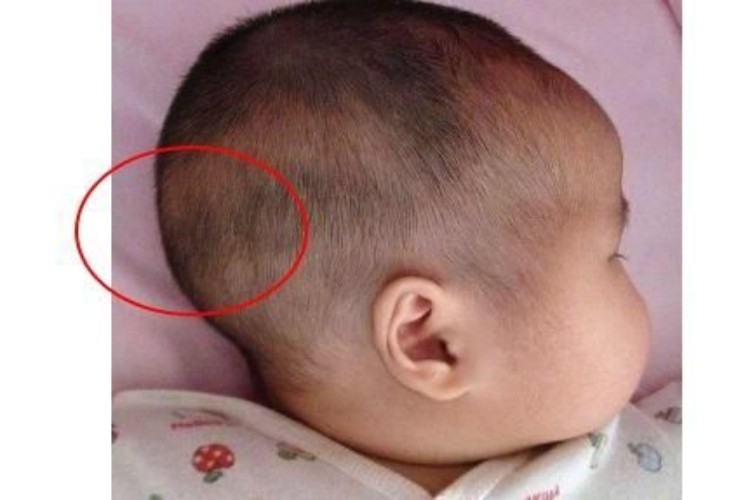 4个月婴儿正常枕骨突出图 4个月婴儿正常枕骨突出图