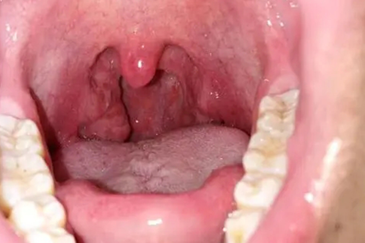 扁桃体周围脓肿图