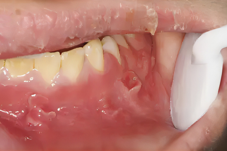 克罗恩病口腔结节图