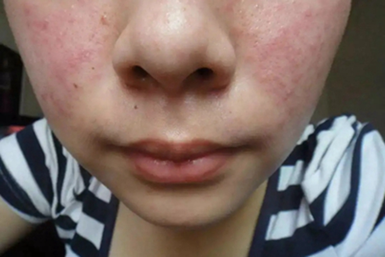 类癌综合征面部症状图 类癌综合征面部症状图