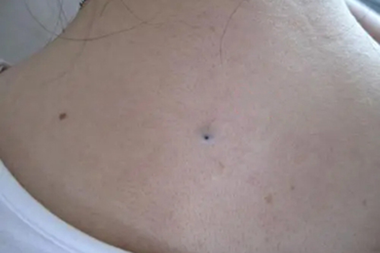 扩张孔后背小黑点图