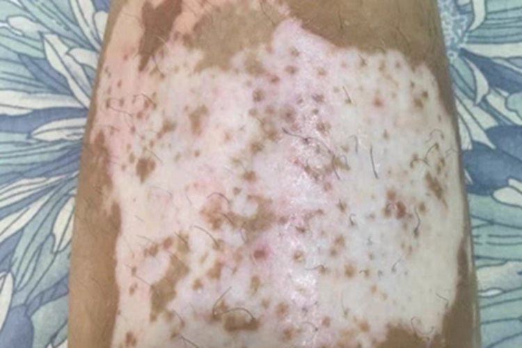 白癜风小腿白斑图