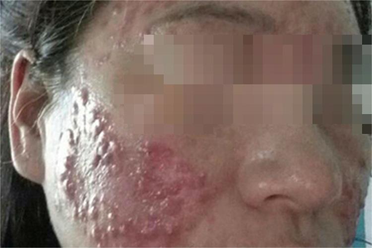 高雄激素性痤疮图