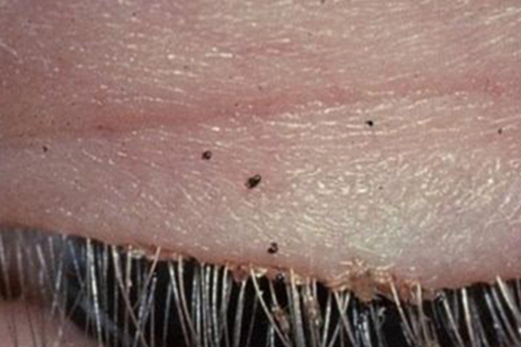 阴虱病眼睑症状图