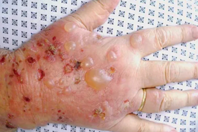 脓疱疮手背红斑图