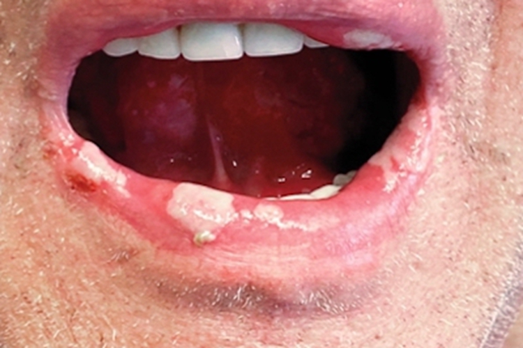 副肿瘤性天疱疮嘴唇溃疡图 副肿瘤性天疱疮嘴唇溃疡图