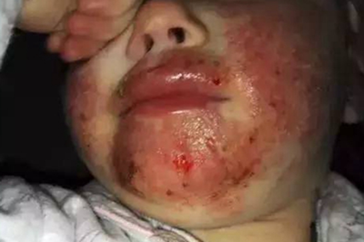 湿疹型多形性日光疹面部糜烂图