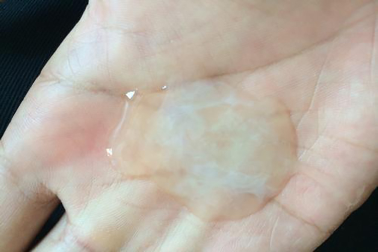 宫颈癌米泔水样分泌物图