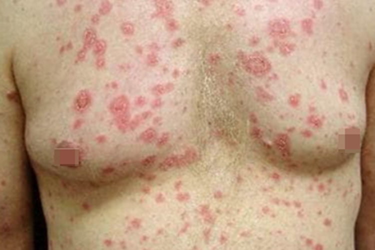 药物性狼疮胸部红斑图