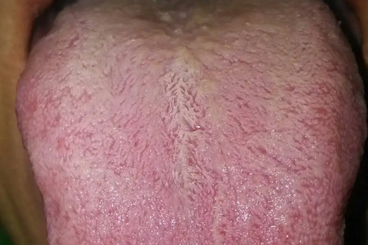 口腔毛状黏膜白斑舌苔发白图