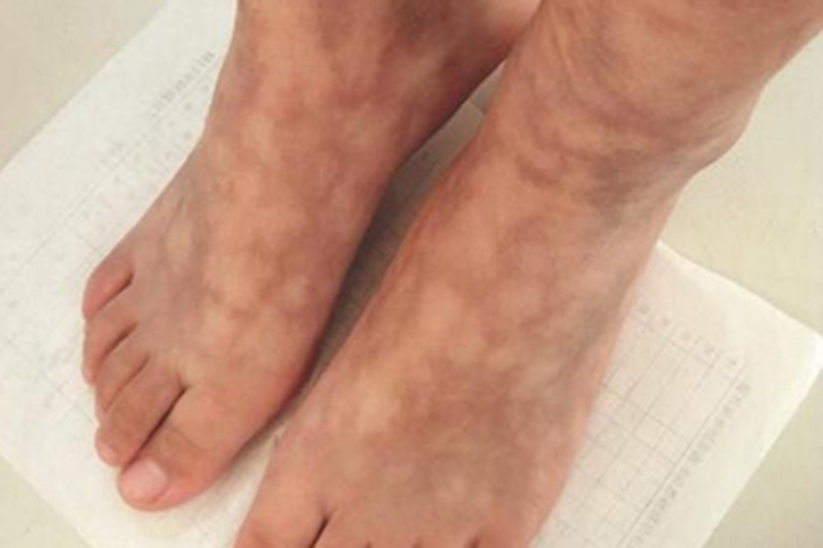 继发性网状青斑脚背症状图