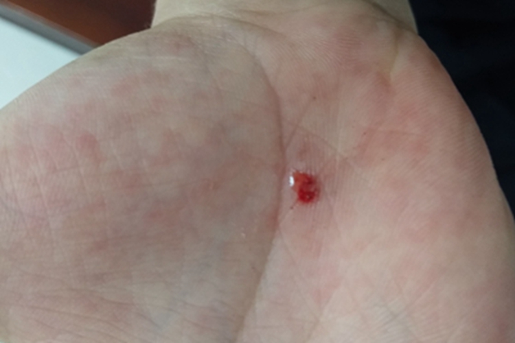 跌伤手掌症状图