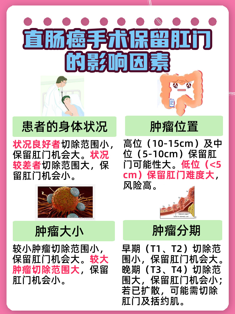 直肠癌手术：保留肛门的关键因素有哪些？