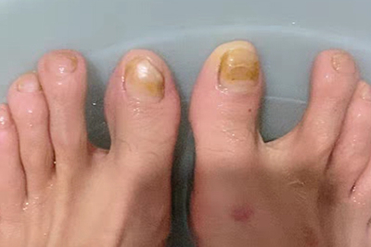 全甲损毁型甲真菌病脚趾甲发黄图 全甲损毁型甲真菌病脚趾甲发黄图