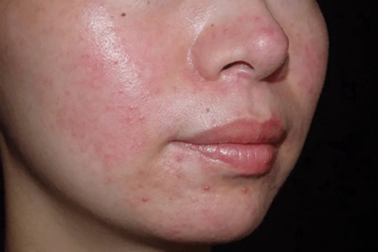 糖皮质激素依赖性皮炎脸上泛红图