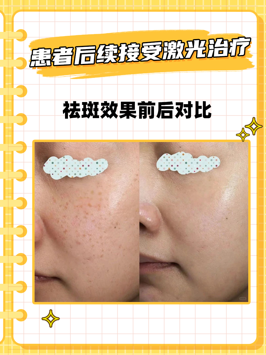 柿子叶祛斑真相:到底可不可行?