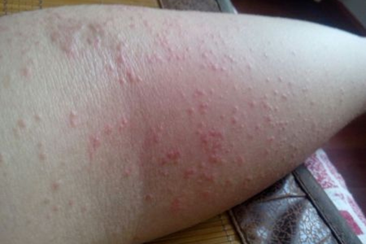 全身过敏湿疹图 全身过敏湿疹图